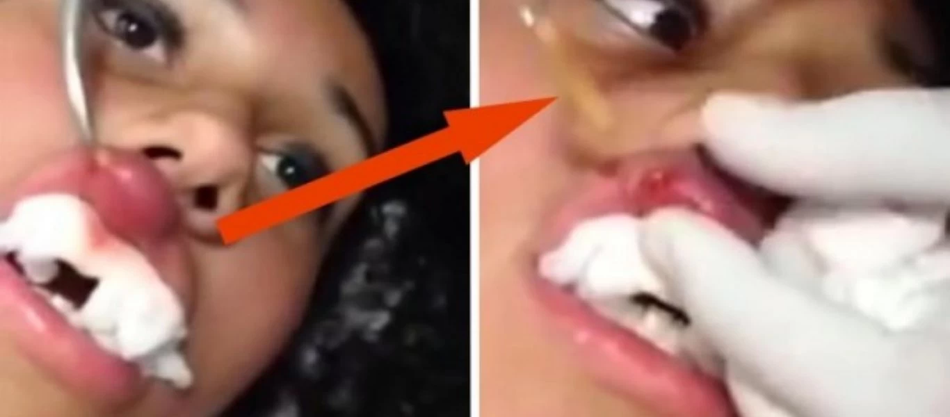 Ένιωσε κάτι να κουνιέται στο χείλος της - Δεν θα πιστέψετε τι έβγαλαν οι γιατροί (βίντεο)